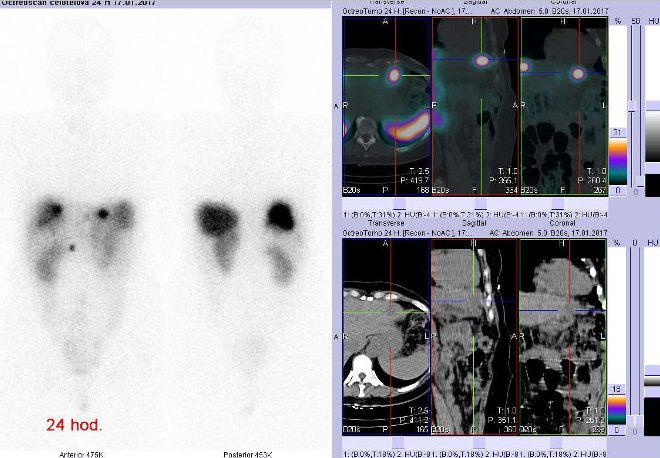 Obr. . 6: Celotlov scintigrafie v pedn a zadn projekci a fze obraz SPECT a CT. Vyeten 24 hod. po aplikaci radioindiktoru. Vpravo zameno na loisko v levm jaternm laloku.