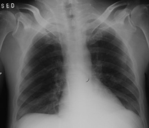 Obr. č. 2: rtg. vyšetření srdce a plic
