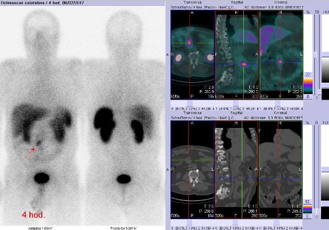 Obr..1: Celotlov scintigrafie vpedn a zadn projekci a fze obraz SPECT a CT. Vyeten 4 hod. po aplikaci radioindiktoru. Vpravo zameno na loisko vmesogastriu vpravo od stedn ry.