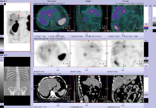 Obr. . 4: Fze obraz SPECT a CT  vyeten bicha a pnve 4 hod. po aplikaci radiofarmaka. Vpravo nahoe fze SPECT a CT, vlevo uprosted SPECT, vlevo dole CT. Zameno na loisko na rozhran obou jaternch lalok.