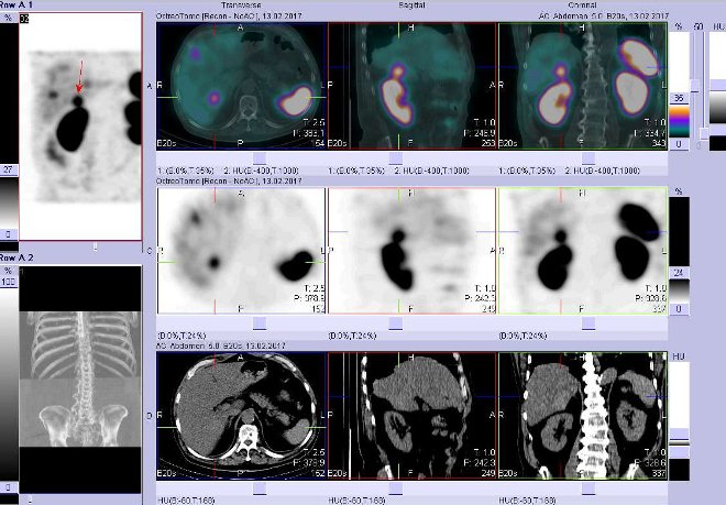 Obr. . 5: Fze obraz SPECT a CT  vyeten bicha a pnve 4 hod. po aplikaci radiofarmaka. Vpravo nahoe fze SPECT a CT, vlevo uprosted SPECT, vlevo dole CT. Zameno na loisko v dorzomediln sti pravho jaternho laloku.