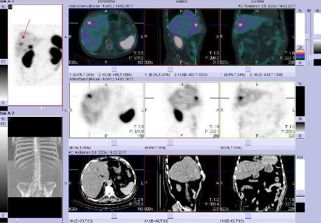 Obr. . 6: Fze obraz SPECT a CT  vyeten bicha a pnve 24 hod. po aplikaci radiofarmaka. Vpravo nahoe fze SPECT a CT, vlevo uprosted SPECT, vlevo dole CT. Zameno na loisko ve ventrolaterln stipravho jaternho laloku.