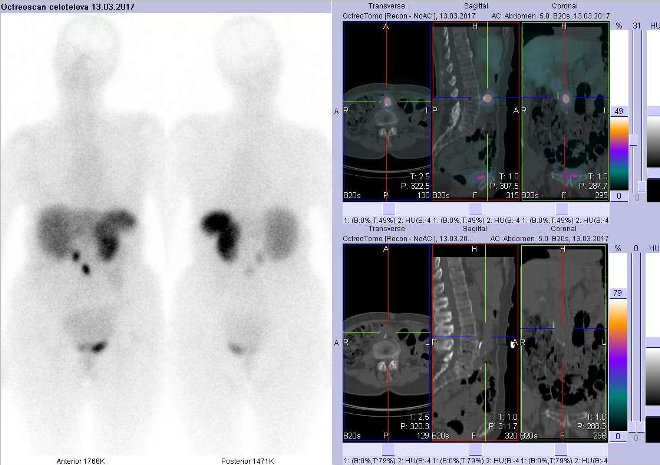 Obr. . 2: Celotlov scintigrafie v pedn a zadn projekci a fze obraz SPECT a CT. Zameno na loisko v epigastriu. Vyeten 4 hod. po aplikaci radioindiktoru.
