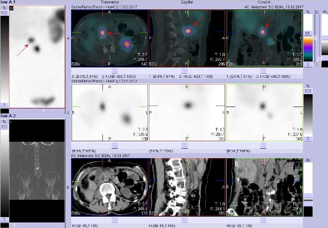 Obr. . 4: Fze obraz SPECT a CT. Zameno na loisko v pravm mesogastriu. Vyeten 4 hod. po aplikaci radioindiktoru.