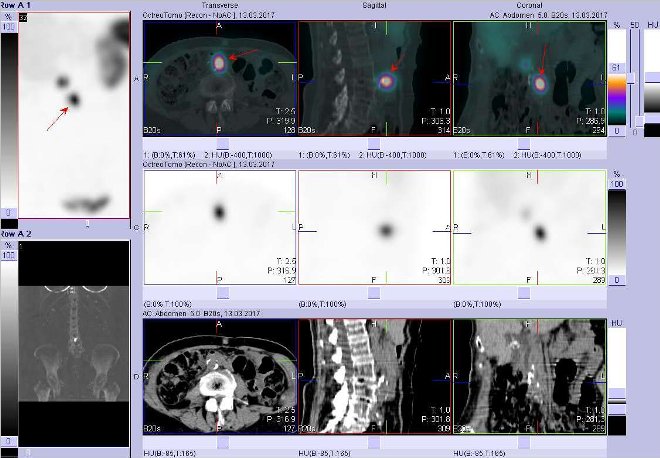 Obr. . 5: Fze obraz SPECT a CT. Zameno na loisko vepigastriu. Vyeten 4 hod. po aplikaci radioindiktoru.