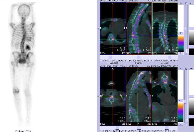 Obr. . 2: Celotlov scintigrafie v zadn projekci a fze obraz SPECT a CT. SPECT/CT zameno na loiska v hrudn ptei.