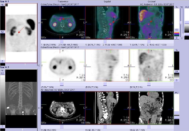 Obr. . 2: Fze obraz SPECT a CT  vyeten bicha a sti pnve 4 hod. po aplikaci radiofarmaka. Vpravo nahoe fze SPECT a CT, vpravo uprosted SPECT, vpravo dole CT. Zameno na loisko v pravm mesogastriu.