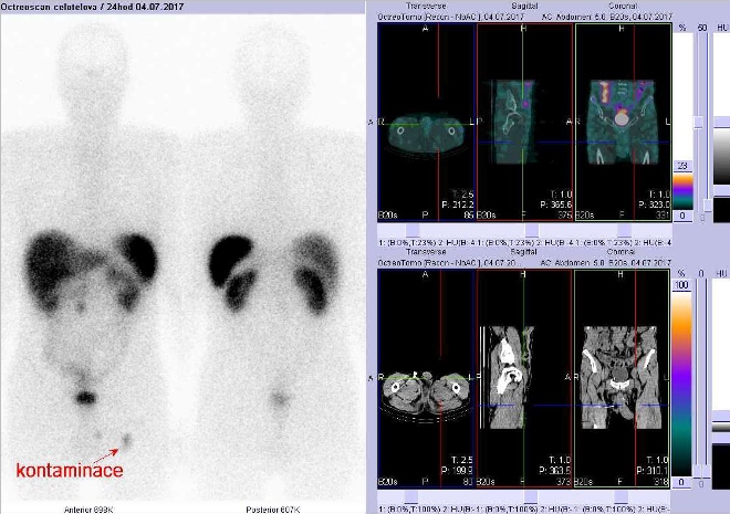 Obr. . 3: Celotlov scintigrafie vpedn a zadn projekci a fze obraz SPECT a CT. Vyeten 24 hod. po aplikaci radioindiktoru. Po celotlov scintigrafii nsledovalo umyt inguinlnch oblast a stehen a pot na SPECT/CT vymizen loiska kontaminace. Vpravo zameno na inguinln oblasti, vpravo nahoe fze SPECT/CT, vpravo dole CT.