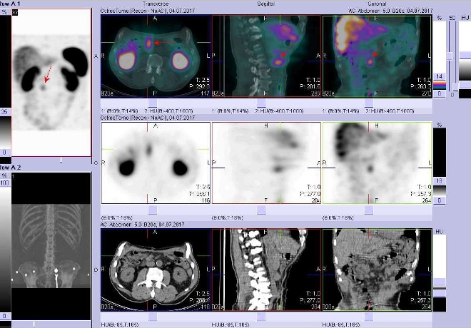 Obr..4: Fze obraz SPECT a CT  vyeten bicha a sti pnve 24 hod. po aplikaci radiofarmaka. Vpravo nahoe fze SPECT a CT, vpravo uprosted SPECT, vpravo dole CT. Zameno na loisko vpravm mesogastriu.