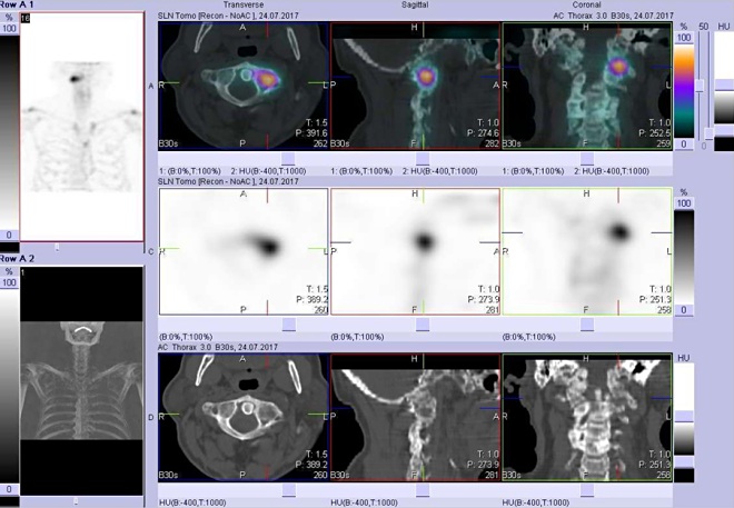 Obr..2: Fze obraz SPECT a CT - zameno na loisko v lev sti obratle C1 - ezy transverzln, sagitln a koronln