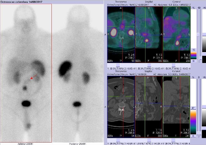 Obr. . 3: Celotlov scintigrafie a fze SPECT/CT bicha 4 hod. po aplikaci OctreoScanu. Zameno na mlo aktivn loisko v duodenu.