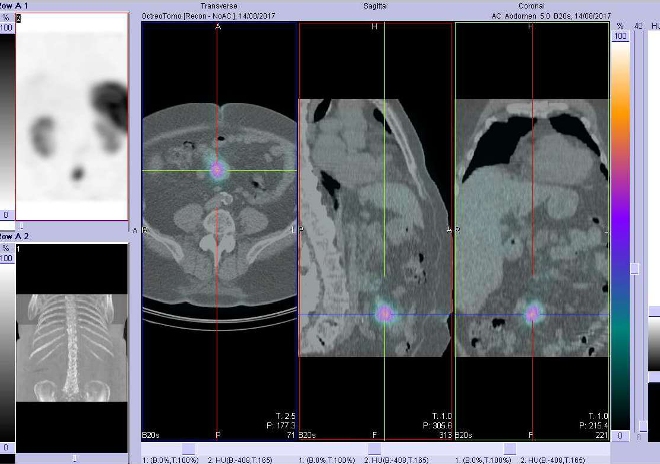 Obr. . 4: Fze SPECT/CT bicha 4 hod. po aplikaci OctreoScanu. Zameno na loisko vmezenteriu vblzkosti pupku.