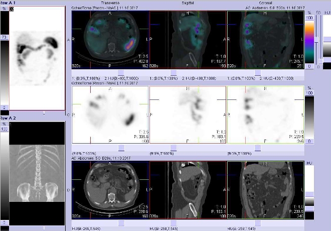 Obr. . 6: Fze obraz SPECT a CT. Vyeten 48 hod. po aplikaci radiofarmaka. Zameno na radioaktivitu v tlustm stev  oblast hepatln flexury.