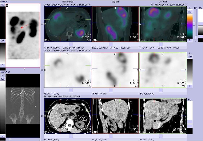 Obr. . 3: Fze obraz SPECT a CT. Vyeten 4 hod. po aplikaci radiofarmaka. Zameno na loisko s nekrzou  ve ventrokaudln sti pravho jaternho laloku.