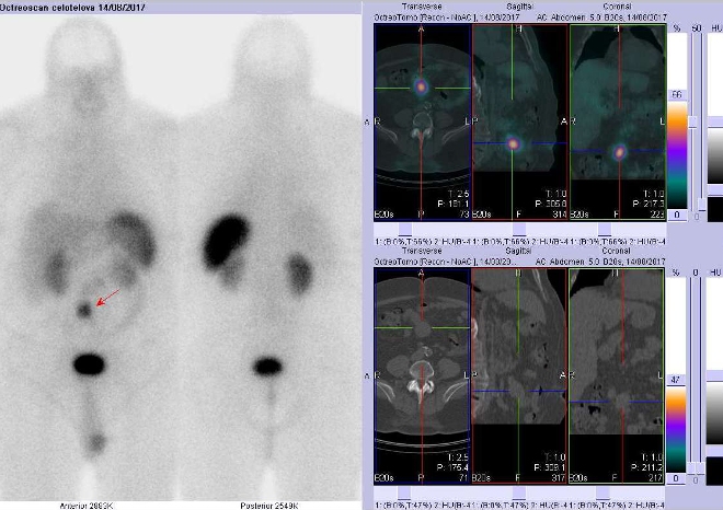 Obr. . 2: Celotlov scintigrafie a fze SPECT/CT bicha 4 hod. po aplikaci OctreoScanu. Zameno na loisko vmezenteriu vblzkosti pupku.