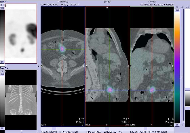 Obr. . 4: Fze SPECT/CT bicha 4 hod. po aplikaci OctreoScanu. Zameno na loisko vmezenteriu vblzkosti pupku.