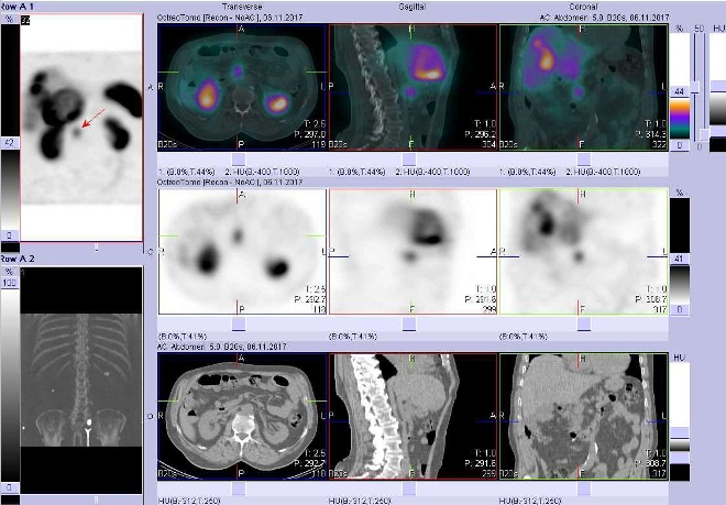 Obr. . 2: Fze obraz SPECT a CT. Vyeten 4 hod. po aplikaci radioindiktoru. Zameno na loisko v hlav pankreatu.