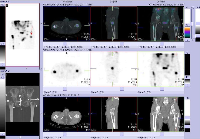 Obr. . 10: Fze obraz SPECT a CT. Vyeten 24 hod. po aplikaci radioindiktoru. Zameno na loisko vlev stehenn kosti.