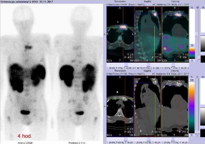 Obr.3: Celotlov scintigrafie v pedn a zadn projekci a fze obraz SPECT a CT. Vyeten 4 hod. po aplikaci radioindiktoru. Vpravo zameno na loisko v levm sternoklavikulrnm sklouben.