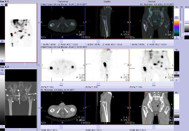Obr. . 9: Fze obraz SPECT a CT. Vyeten 24 hod. po aplikaci radioindiktoru. Zameno na loisko v prav stehenn kosti.