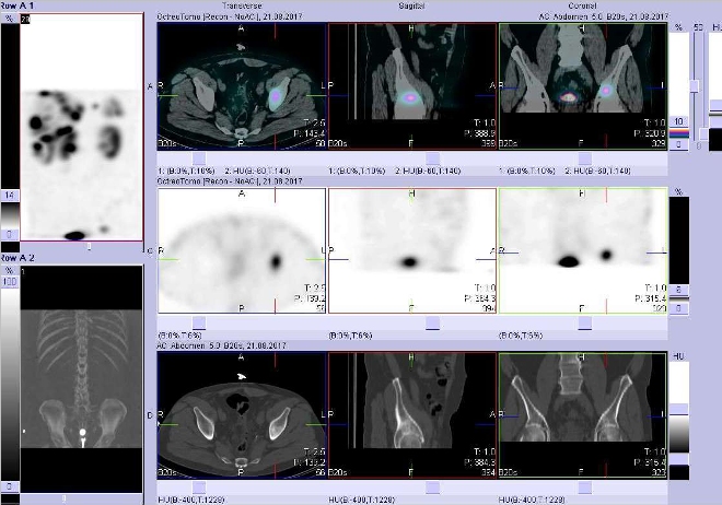 Obr. . 4: Fze obraz SPECT a CT. Vyeten 4 hod. po aplikaci radioindiktoru. Zameno na loisko vkosti kyeln vlevo nad acetabulem.