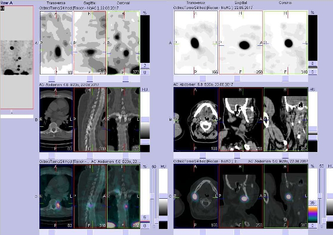 Obr. . 6: Fze obraz SPECT a CT. Vyeten 24 hod. po aplikaci radioindiktoru. Zameno na loisko vhrudnm obratli a v krn uzlin vpravo.