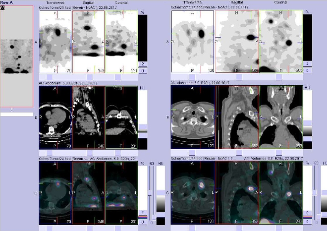 Obr. . 8: Fze obraz SPECT a CT. Vyeten 24 hod. po aplikaci radioindiktoru. Zameno na loisko v mediastinu na perikardu ventrln a v kln kosti vlevo mediln.