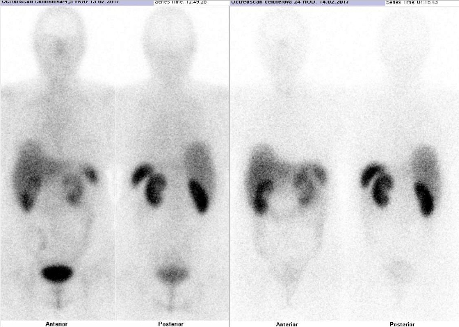 Obr..1: Celotlov scintigrafie vpedn a zadn projekci. Vyeten 4 hod. (vlevo) a 24 hod. (vpravo) po aplikaci radioindiktoru.