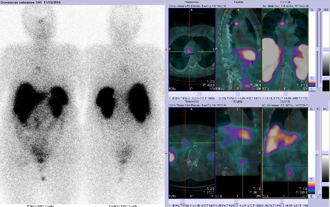 Obr. . 1: Celotlov scintigrafie v pedn a zadn projekci a fze SPECT/CT 24 hod. po aplikaci OctreoScanu. Zameno na loisko v hrudnku tsn vpravo od stedn ry.