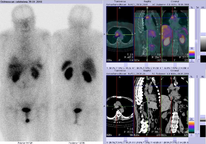 Obr. . 3: Celotlov scintigrafie v pedn a zadn projekci a fze SPECT/CT 4 hod. po aplikaci OctreoScanu. Zameno na loisko v hrudnku tsn vpravo od stedn ry.