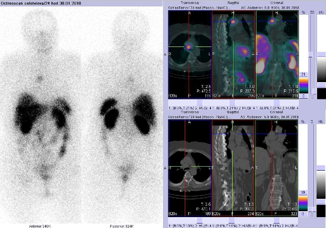 Obr. . 4: Celotlov scintigrafie v pedn a zadn projekci a fze SPECT/CT 24 hod. po aplikaci OctreoScanu. Zameno na loisko v hrudnku tsn vpravo od stedn ry.