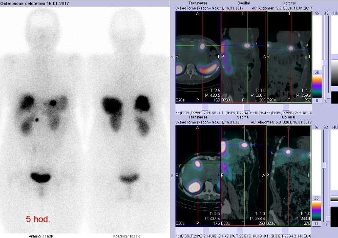 Obr. . 1: Celotlov scintigrafie v pedn a zadn projekci a fze obraz SPECT a CT. Vyeten 5 hod. po aplikaci radioindiktoru. Vpravo nahoe zameno na loisko v levm jaternm laloku, vpravo dole zameno na loisko v pravm laloku ventrokraniln.