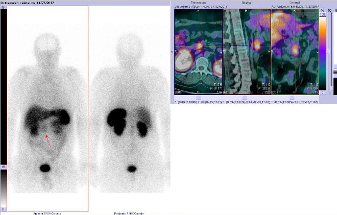 Obr..2: Celotlov scintigrafie a fze obraz SPECT a CT. Vyeten 7 hod. po aplikaci radioindiktoru. Zameno na loisko vpankreatu nebo lymfatick uzlin.
