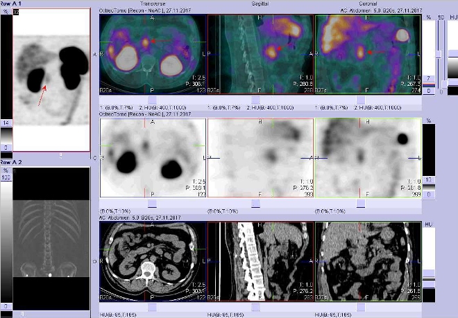 Obr.3: Fze obraz SPECT a CT. Vyeten 7 hod. po aplikaci radioindiktoru. Zameno na loisko v pankreatu nebo lymfatick uzlin.