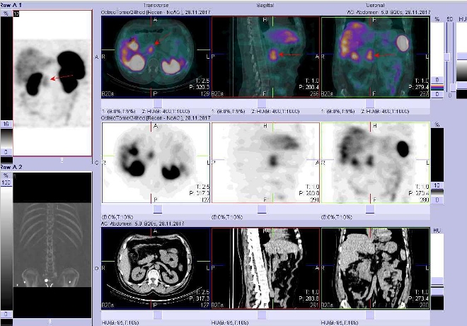 Obr. . 7: Fze obraz SPECT a CT. Vyeten 24 hod. po aplikaci radioindiktoru. Zameno na loisko vpankreatu nebo lymfatick uzlin.