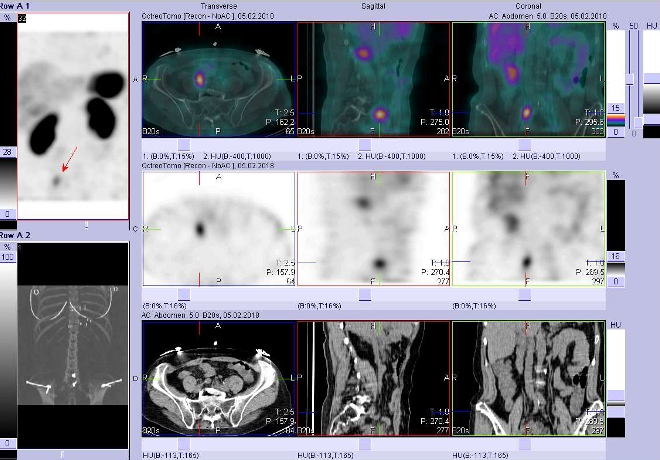 Obr. . 3: Fze obraz SPECT a CT. Vyeten 5 hod. po aplikaci radioindiktoru. Zameno na stevo.