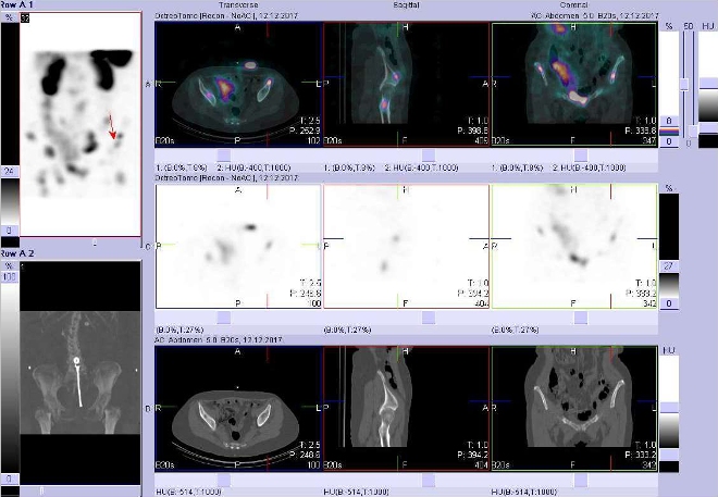 Obr. . 11: Fze obraz SPECT a CT. Zameno na loisko vlev kosti kyeln. Vyeten 24 hod. po aplikaci OctreoScanu.