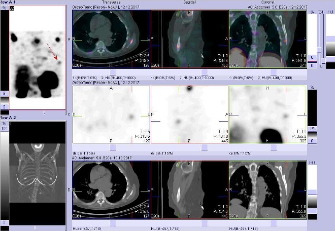 Obr. . 20: Fze obraz SPECT a CT. Zameno na loisko vlev lopatce. Vyeten 24 hod. po aplikaci OctreoScanu.