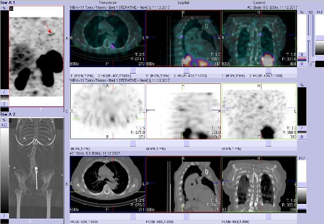 Obr. . 4: Fze obraz SPECT a CT. Zameno na loisko kostovertebrln vlevo. Vyeten 5 hod. po aplikaci OctreoScanu.