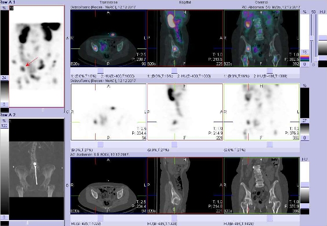 Obr. . 6: Fze obraz SPECT a CT. Zameno na loisko v prav kosti kyeln. Vyeten 24 hod. po aplikaci OctreoScanu.