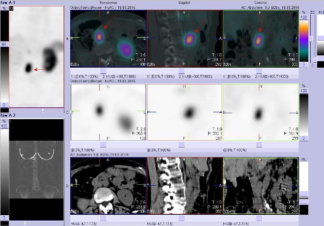 Obr. . 3: Fze obraz SPECT a CT. Zameno na loisko paraaortln vpravo vuzlin vrovni L2/L3. Vyeten 4 hod. po aplikaci radioindiktoru.
