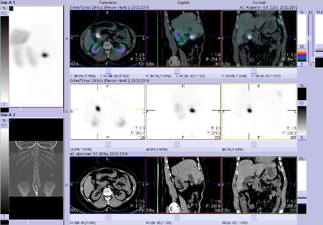 Obr. . 4: Fze obraz SPECT a CT. Vyeten 4 hod. po aplikaci radioindiktoru. Zameno na loisko mezi pankreatem a duodenem.