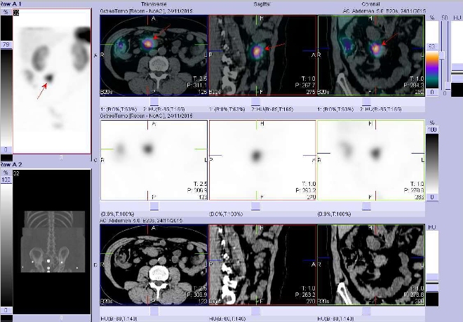 Obr. . 2: SPECT, CT a fze obraz SPECT a CT. Vyeten 24 hod. po aplikaci radioindiktoru. Nahoe fze obraz, uprosted obrazy SPECT, dole obrazy CT, vdy vlevo transverzln  ezy, uprosted sagitln ezy, vpravo ezy koronrn. Zameno na loisko v bie vpravm mesogastriu.