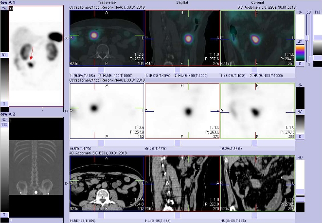 Obr. . 5: SPECT, CT a fze obraz SPECT a CT. Vyeten 24 hod. po aplikaci radioindiktoru. Nahoe fze obraz, uprosted obrazy SPECT, dole obrazy CT, vdy vlevo transverzln  ezy, uprosted sagitln ezy, vpravo ezy koronrn. Zameno na loisko v bie vpravm mesogastriu.