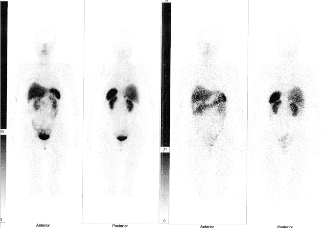 Obr. . 2: Celotlov scintigrafie v pedn a zadn projekci 4 (vlevo) a 24 (vpravo) hod. po aplikaci OctreoScanu.