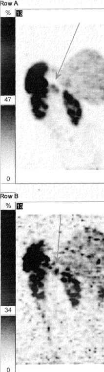 Obr. . 5: SPECT bicha 24 hod. po aplikaci OctreoScanu. Zameno na loisko vlevo od stedn ry vblzkosti sleziny (hornho plu lev ledviny).