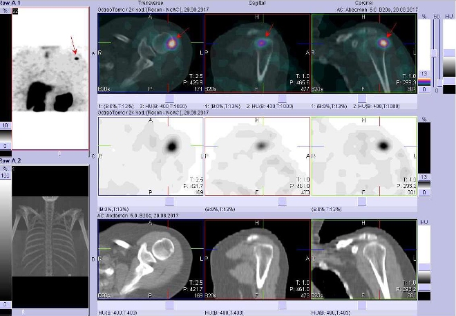 Obr. . 3: Fze obraz SPECT a CT. Vyeten 24 hod. po aplikaci radioindiktoru. Zameno na loisko v laterln sti hlavice lev pan kosti.