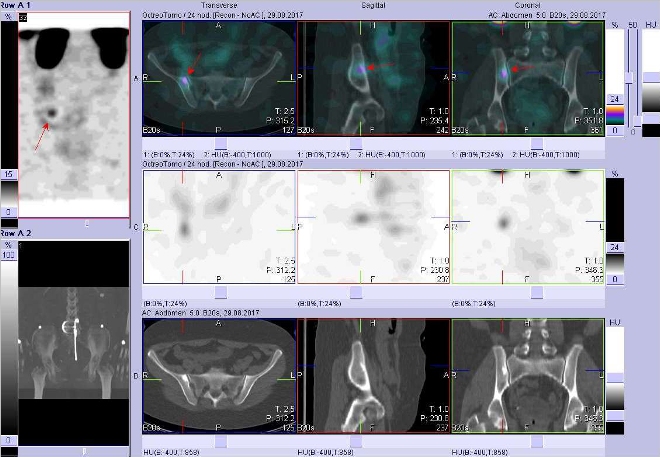 Obr. . 4: Fze obraz SPECT a CT. Vyeten 24 hod. po aplikaci radioindiktoru. Zameno na loisko vkosti kyeln vpravo tsn u SI sklouben.