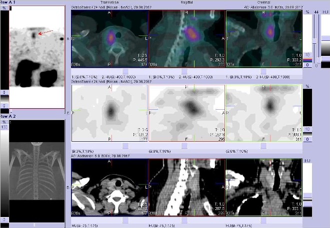 Obr. . 5: Fze obraz SPECT a CT. Vyeten 24 hod. po aplikaci radioindiktoru. Zameno na prav lalok ttn lzy.