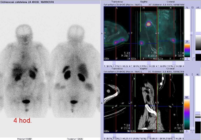 Obr. . 5: Celotlov scintigrafie vpedn a zadn projekci a fze SPECT/CT 4 hod. po aplikaci OctreoScanu. Zameno na podkon loiska vrovni pechodu bicha a pnve vlevo.
